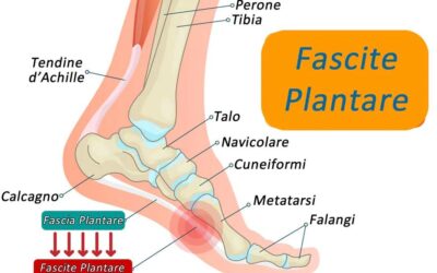 La fascite plantare