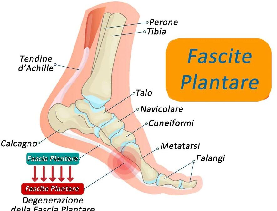 Illustrazione della Fascite plantare