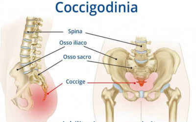 Coccigodinia : cause e rimedi